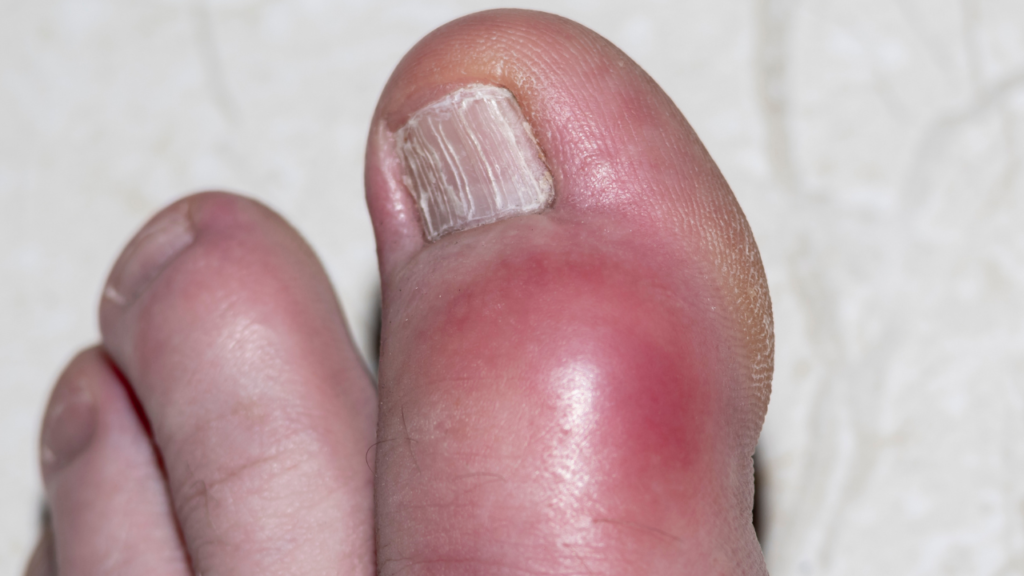 Best Over-the-Counter Medicines for Gout: Relief and Dosage Instructions
